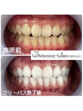 ホワイトニングサロン 京都烏丸店/ホワイトニング施術例