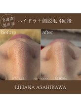 リリアーナ アサヒカワ(LILIANA ASAHIKAWA)/ハイドラ毛穴洗浄＋顔脱毛