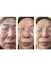 ベラーモ(BELLAMO)/肌質改善