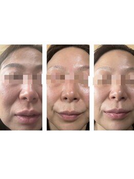 ベラーモ(BELLAMO)/肌質改善