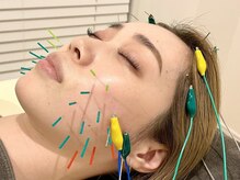 博多鍼灸整骨院 整体院の雰囲気（電気を流す美容鍼でリフトアップ◎【美容鍼/小顔矯正/整体院】）