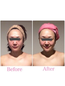 TKC 東京小顔センター五反田店/ビフォーアフター【むくみ改善】