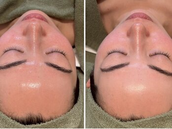 ヴィヴァンビー(Vivant+B)/before/after