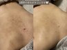 【BODY☆背中上部ニキビケア】ハーブピーリングで根本改善◎リアクションあり