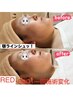 たるみシワ改善【韓国肌管理】一ヵ所レッドショットxハイパーナイフ     40分