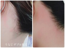 サロン ド モア(salon de MORE)/うなじのダブル脱毛