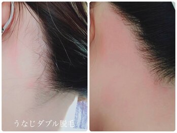 サロン ド モア(salon de MORE)/うなじのダブル脱毛