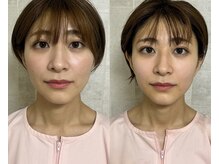 マホロバ(mahoroba)/美容鍼＋全身鍼