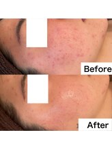 リラ(Lilas)/ハーブ３回