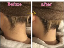 リジュベ(Rejuve)/美肌脱毛/美肌/船橋/メンズ