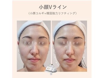 ルナビューティー 赤坂(LUNA beauty)/ 韓国美容◆強力リフティング