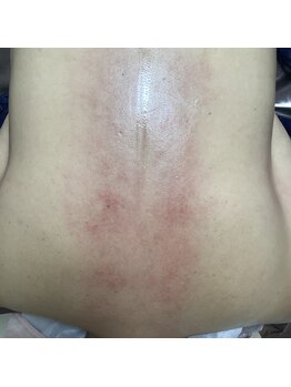 ピュリフィケーション(Purification)/すごか~背中に溜まった老廃物!