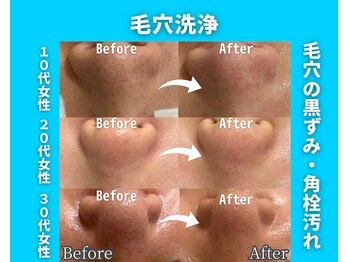 イーラボ 池袋店(e-LABO)/毛穴洗浄/ハイドロフェイシャル