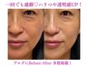 【毛穴+エイジング】［全顔+首］ 深層ピーリング×毛穴洗浄×美容液 ¥19,800