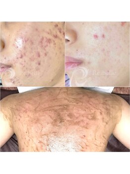 アブソリュートワン(absolute1)の写真/お顔・背中/二の腕/ヒップのニキビケア・ざらつきに!つるんと透明感ある美肌作り+ブライダルさんにも人気♪