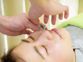 あさひろはりきゅう接骨院 浦安院の写真/【鍼初心者の方も大歓迎◎】小顔矯正×美容鍼でスッキリむくみ解消/リフトアップ♪理想のフェイスラインへ