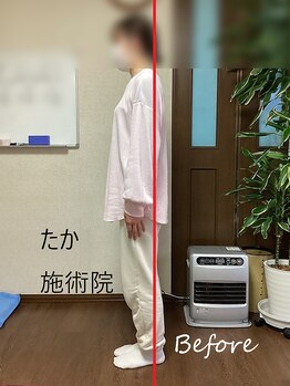 たか施術院/ 頭痛 肩こり 20代学生 初回