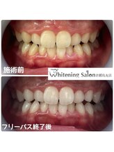 ホワイトニングサロン 京都烏丸店/ホワイトニング施術例