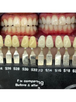 トウキョースワーズ 渋谷店(TOKYO SWRS)/#ホワイトニング #渋谷 #池袋
