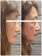 長寿鍼灸院 長寿整骨院/美容鍼50本の効果★小顔効果