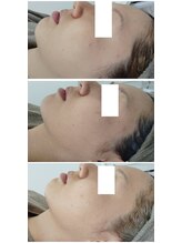 ビーユー(Be.you)/肌荒れ、小顔