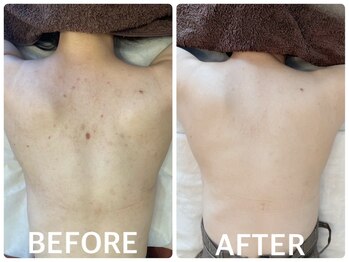 ハーブピーリング 心斎橋/背中ニキビ改善