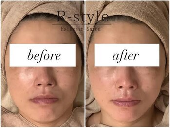 エステサロン アールスタイル(R-style)/テラボーラービフォア写真