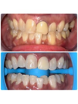 コナホワイトニング 神保町/3ヶ月ホワイトニング