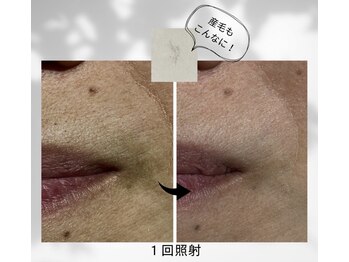 ユジュ(yju)の写真/【松戸駅1分】顔脱毛も1回ごとの都度払いOK◎他気になるパーツだけでも通いやすい、美肌脱毛サロン♪
