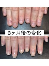 アンドネイル 海老名(&nail)/自爪育成ジェル3ヶ月後の変化☆