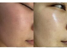 ゼニス 池袋本店(ZENITH)/ララピール 施術BeforeAfter