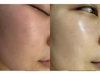 ゼニス 池袋本店(ZENITH)/ララピール 施術BeforeAfter