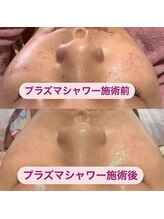 アルティ 福岡大名店(ARTI,)/プラズマ！