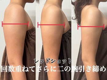 アンドエス 六本木(and S.)/回数を重ねて更に脂肪スッキリ♪