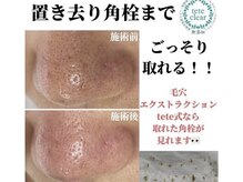 リッカロッカ(RIKKA&ROCCA)/毛穴エクストラクション