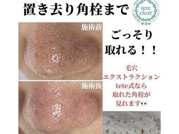 リッカロッカ(RIKKA&ROCCA)/毛穴エクストラクション