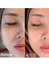 チェイル(JEIL)/ハーブピーリング 