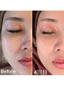 チェイル(JEIL)/ハーブピーリング 