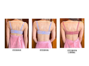 エミニナル(EMININAL)/バストケア【ビフォーアフター】