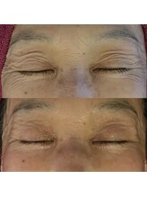 ワッカ(wacca)/【ヒト幹細胞】ビフォーアフター