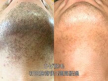 エクレ 柏店(EKURE)/ヒゲ脱毛