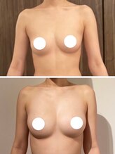 美人バスト アンド ヒップアップ 広島店/バストアップ症例写真