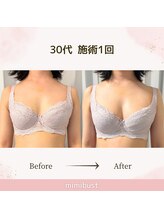ミミバスト(mimibust)/バストアップBeforeAfter