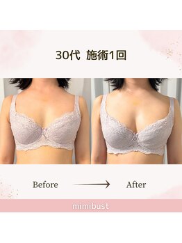 ミミバスト(mimibust)/バストアップBeforeAfter
