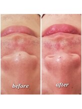 エクラ(eclat)/ハイドラフェイシャル