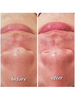 エクラ(eclat)/ハイドラフェイシャル