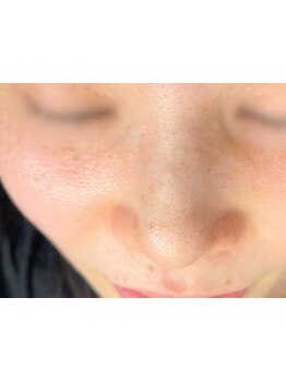 シミしわ改善！予防ケア