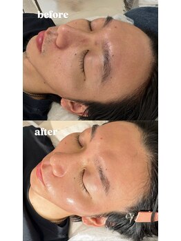 オッターヴァ 学芸大学(8va.)/フルフェイシャルwax脱毛