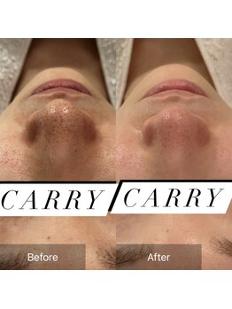 ルネアススパ 南青山(Lune’as Spa)/毛穴ケア