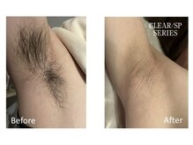 ベルフィオーレ(bel fiore)/メンズ脱毛　脇